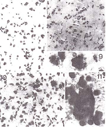 neuroleptic therapy- significant tissue damage - black dots represent scar tissue